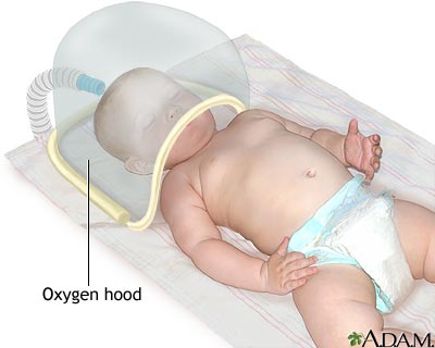 Oxygen Hood by MedlinePlus